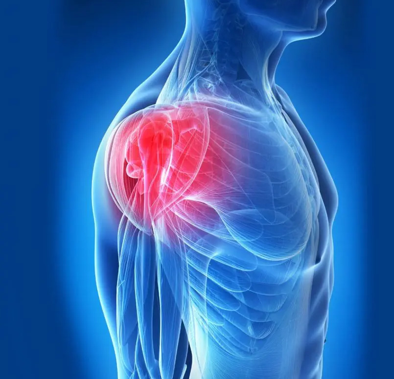 Cirugía de Hombro
Patologías frecuentes
¿CUÁLES SON?
Bursitis: las bursas son estructuras en forma de saco que permiten el deslizamiento suave de las estructuras móviles del hombro. su inflamación debido al movimiento repetitivo es una causa frecuente de dolor.